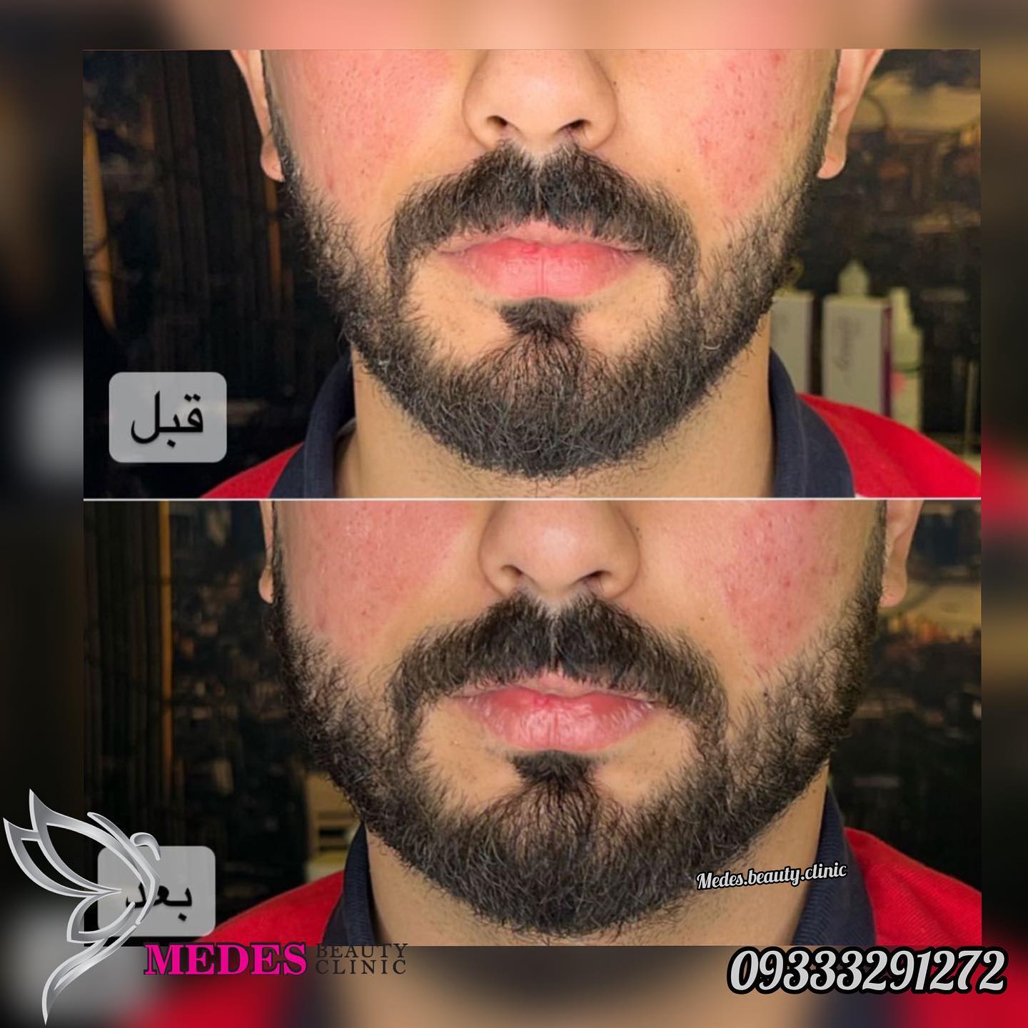 گالری زاویه سازی صورت